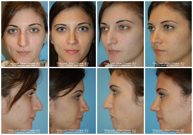 rhinoplasty